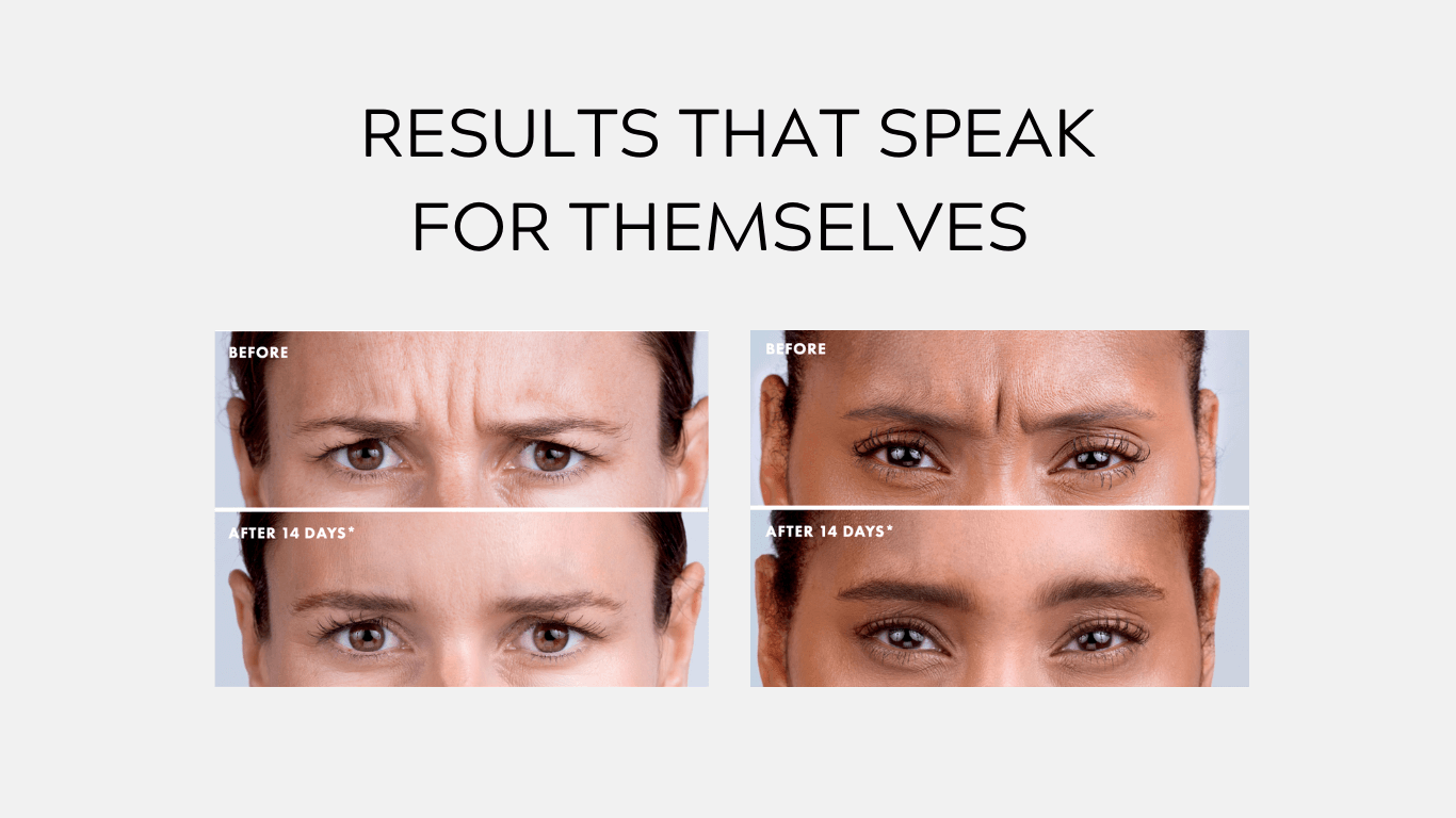 Results that speak for themselves. 2 before and after images showing just the women's eyes and foreheads. The women in the befores have noticeably more wrinkles in their forehead and none in the after photos.