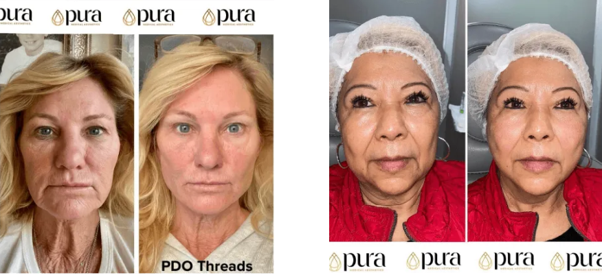 Before and After Treatments at Pura Medical Aesthetics