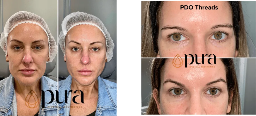 Before and After Treatments at Pura Medical Aesthetics